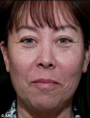 Results: Donna Keller seen prior to her traditional, full anesthesia facelift (left) and then afterwards (right)