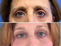 endobrow