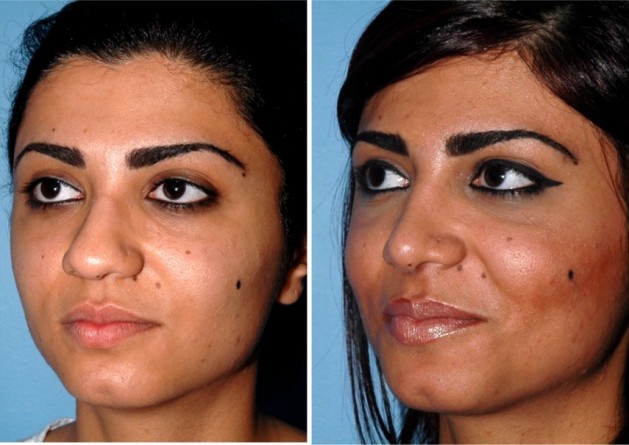 Middle Eastern Nose Job