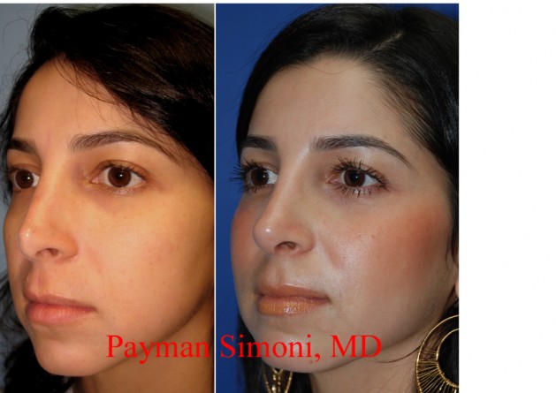 Redo Nose Job