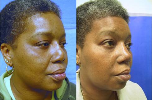 Rhinoplasty for Black Ethnic Noses