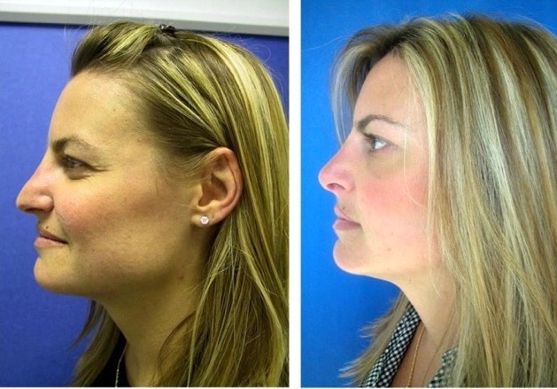 Rhinoplasty Beverly Hills
