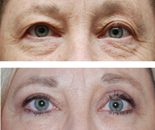 Best Eyelid Surgeon in Califronia